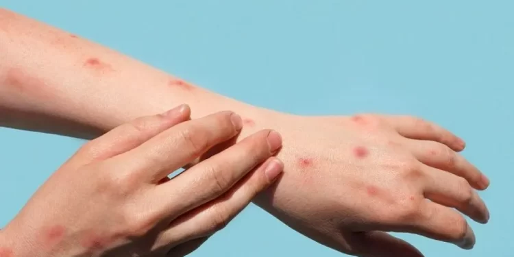 El Ministerio de Salud de la nación emitio un alerta epidemiológico tras confirmar que cuatro ciudadanos Uruguayos con sarampión ingresaron desde Bolivia y viajaron por territorio Argentino una de las paradas fue la ciudad de Totoras